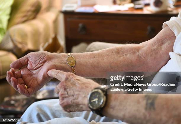 Allen Coller indicates a scar on his right arm from a complication after his transplant surgery. At the home of Allen and Beth Coller in Exeter...