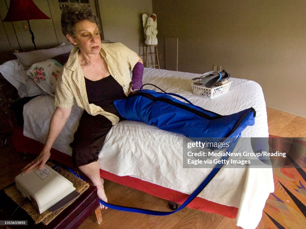 Photo by Lauren A. LittleMay 4, 2008LymphedemaBarbara Starr has lymphedema in her left leg, which means the leg fills with fluid. Here she puts the pump she wears overnight on her leg, it massages the fluid out of her leg.&#