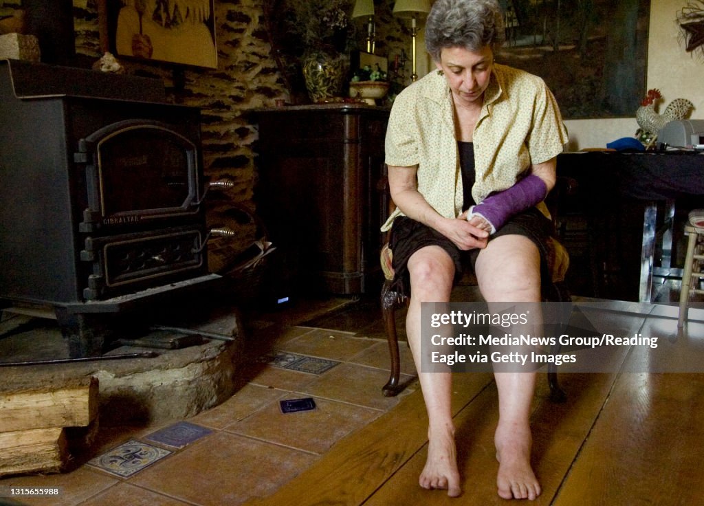 Photo by Lauren A. LittleMay 4, 2008LymphedemaBarbara Starr has lymphedema in her left leg, which means the leg fills with fluid.Here, you can see how much bigger her left leg is than her right leg.