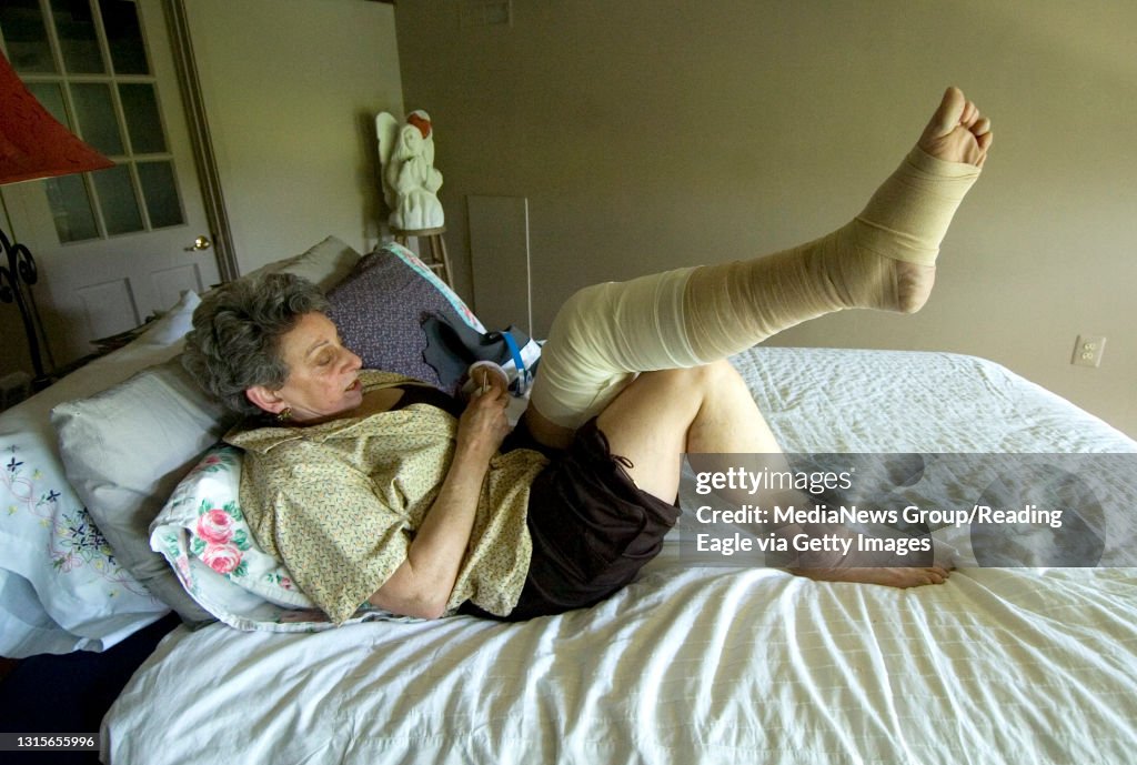 Photo by Lauren A. LittleMay 4, 2008LymphedemaBarbara Starr has lymphedema in her left leg, which means the leg fills with fluid. Here she wraps her leg, which is difficult because she broke her wrist. &#