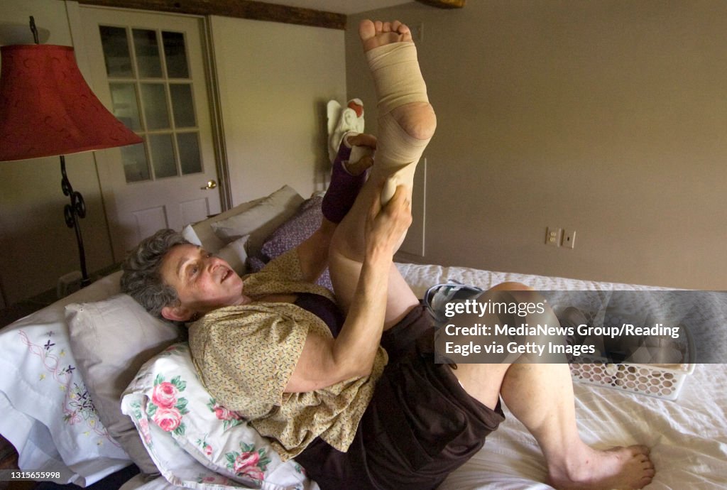 Photo by Lauren A. LittleMay 4, 2008LymphedemaBarbara Starr has lymphedema in her left leg, which means the leg fills with fluid.Here she wraps her leg, which is difficult because she broke her wrist. 
