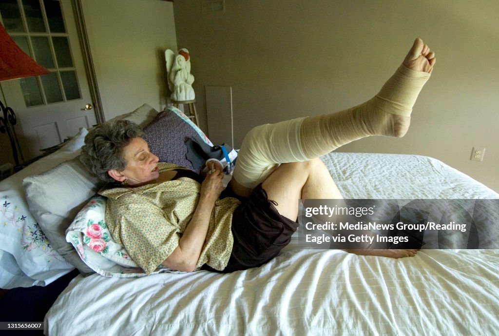 Photo by Lauren A. LittleMay 4, 2008LymphedemaBarbara Starr has lymphedema in her left leg, which means the leg fills with fluid. Here she wraps her leg, which is difficult because she broke her wrist. &#