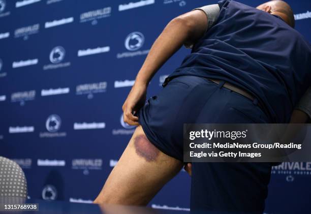 Penn State head coach James Franklin shows his bruises from a team paintball outing during Penn State football media day on Saturday, August 4, 2018...