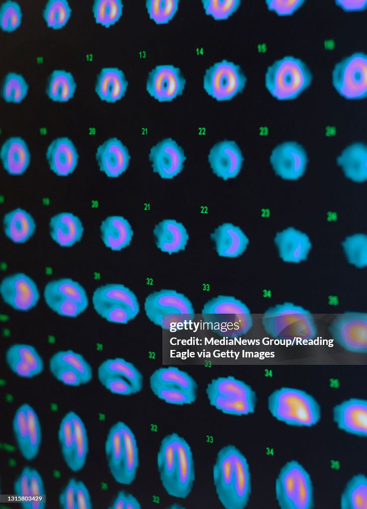 8/18/2009 Reading, PAA scan of a person's heart on a computer screen at the St. Joseph Medical Center Radiology department Tuesday afternoon. Technetium ( TC99M ) is commonly used in nuclear medicine, but is in short supply as a resul