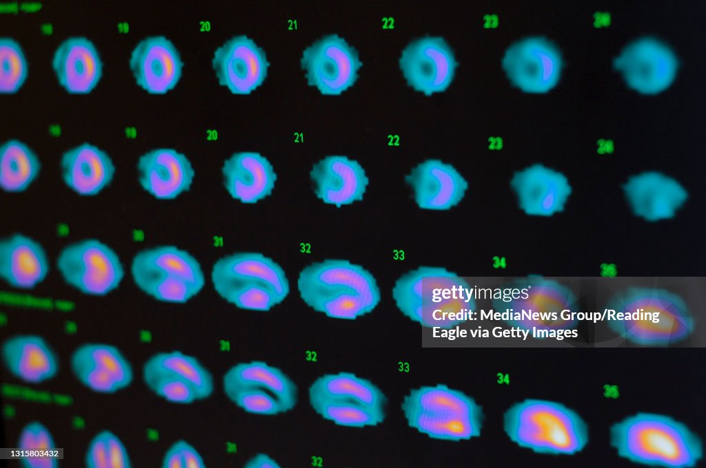 8/18/2009 Reading, PAA scan of a person's heart on a computer screen at the St. Joseph Medical Center Radiology department Tuesday afternoon. Technetium ( TC99M ) is commonly used in nuclear medicine, but is in short supply as a resul