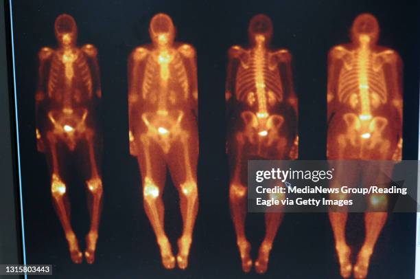 Reading, PAA whole body bone scan on a computer screen at the St. Joseph Medical Center Radiology department Tuesday afternoon. Technetium is...