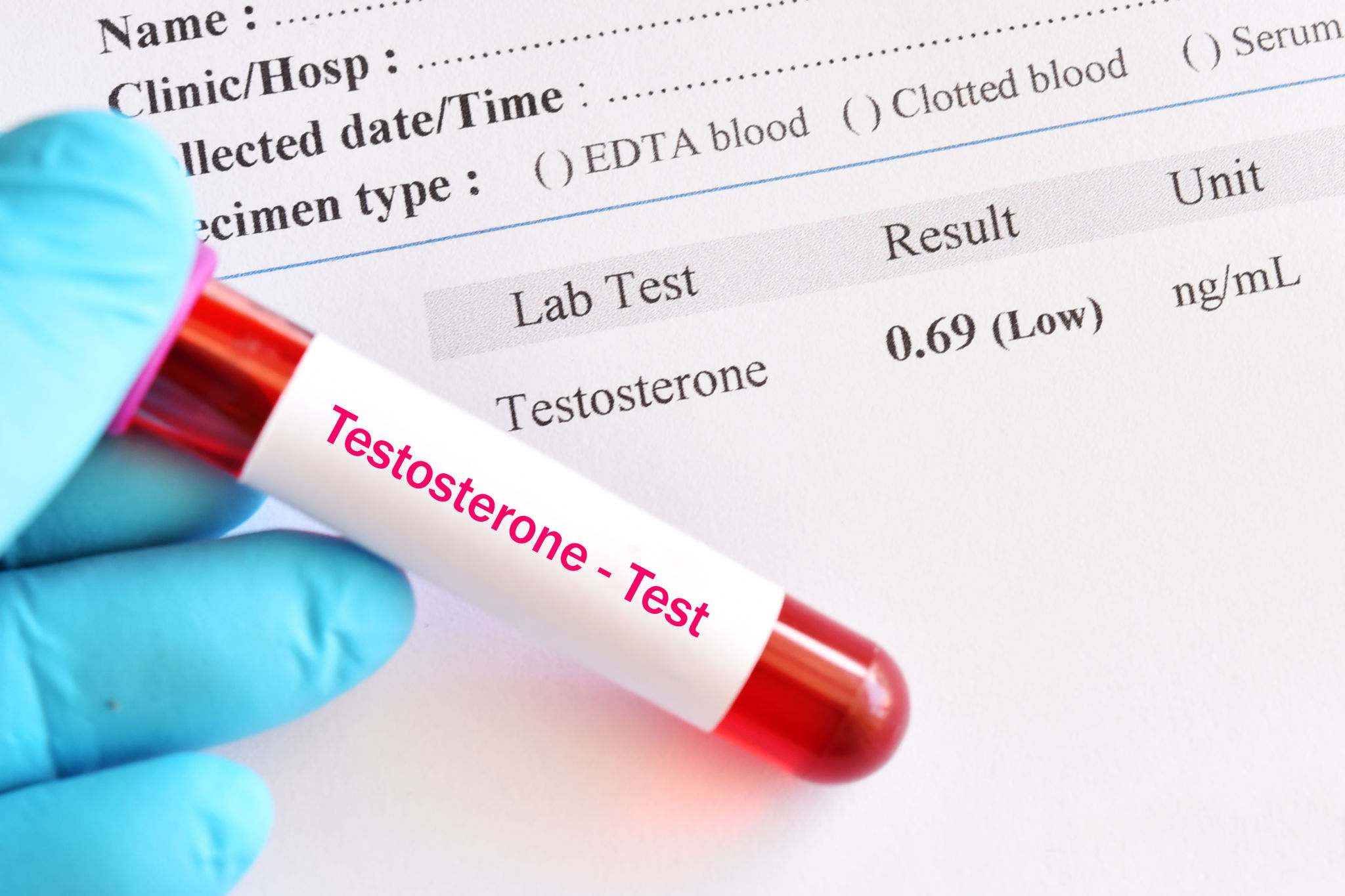 Abnormal low testosterone hormone test result Abnormal low testosterone hormone test result