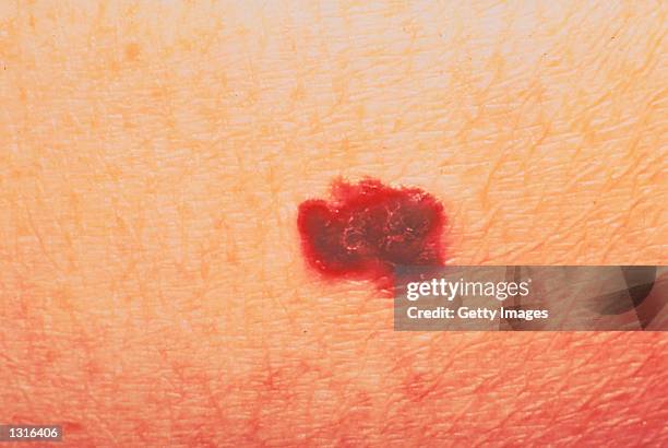 Detail of a person with a malignant melanoma, which is a malignant skin tumor that involves the skin cells that produce pigment.