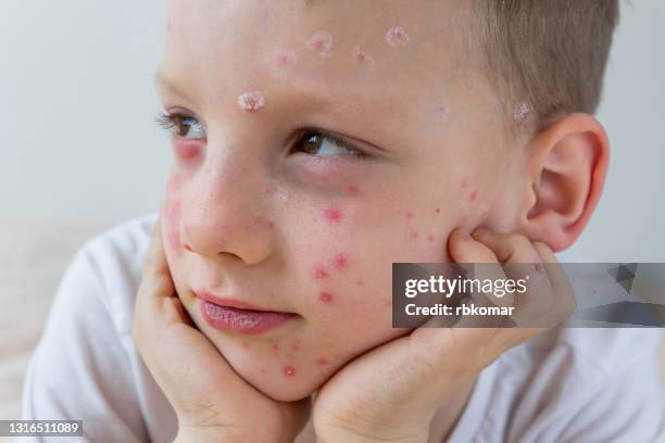 portrait of a little boy with chicken pox disease close-up. the condition of the skin on the face of a child with an allergic rash - eczema child stock-fotos und bilder