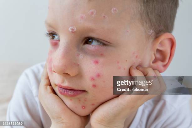 portrait of a little boy with chicken pox disease close-up. the condition of the skin on the face of a child with an allergic rash - varicella foto e immagini stock