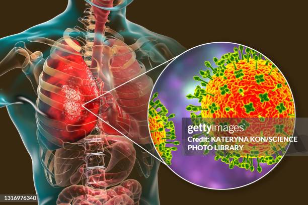 nipah virus in lungs, illustration - infectious disease stock illustrations