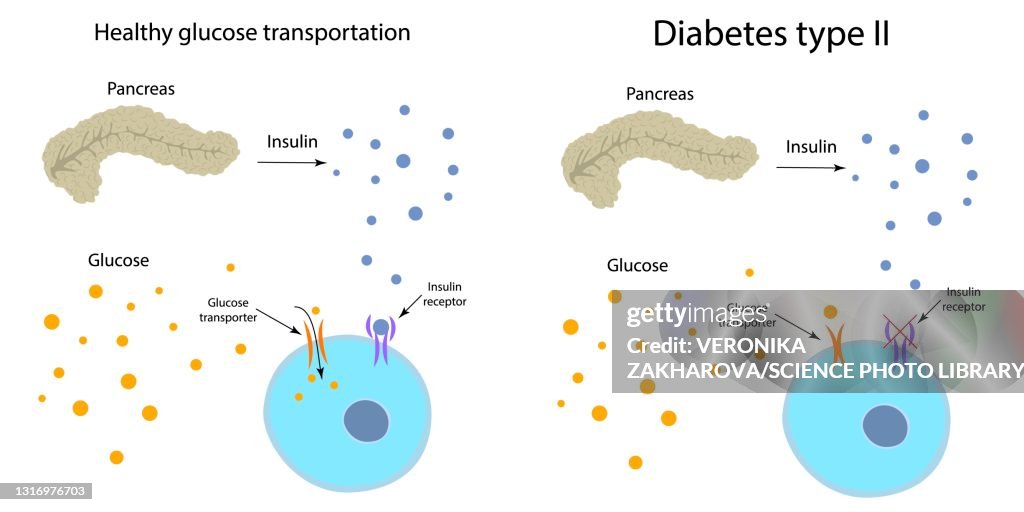 Diabetes type 2 and healthy glucose metabolism, illustration