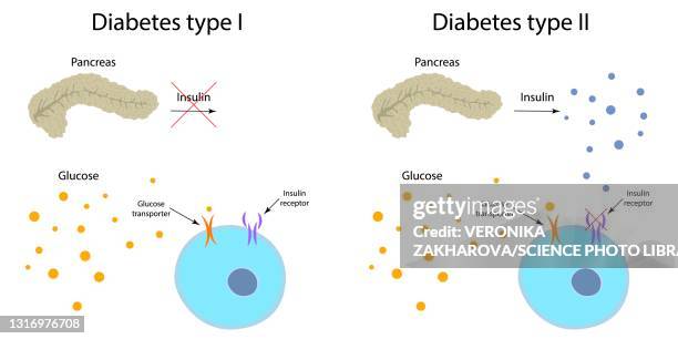 diabetes type 1 and 2, illustration - hyperglycemia stock illustrations
