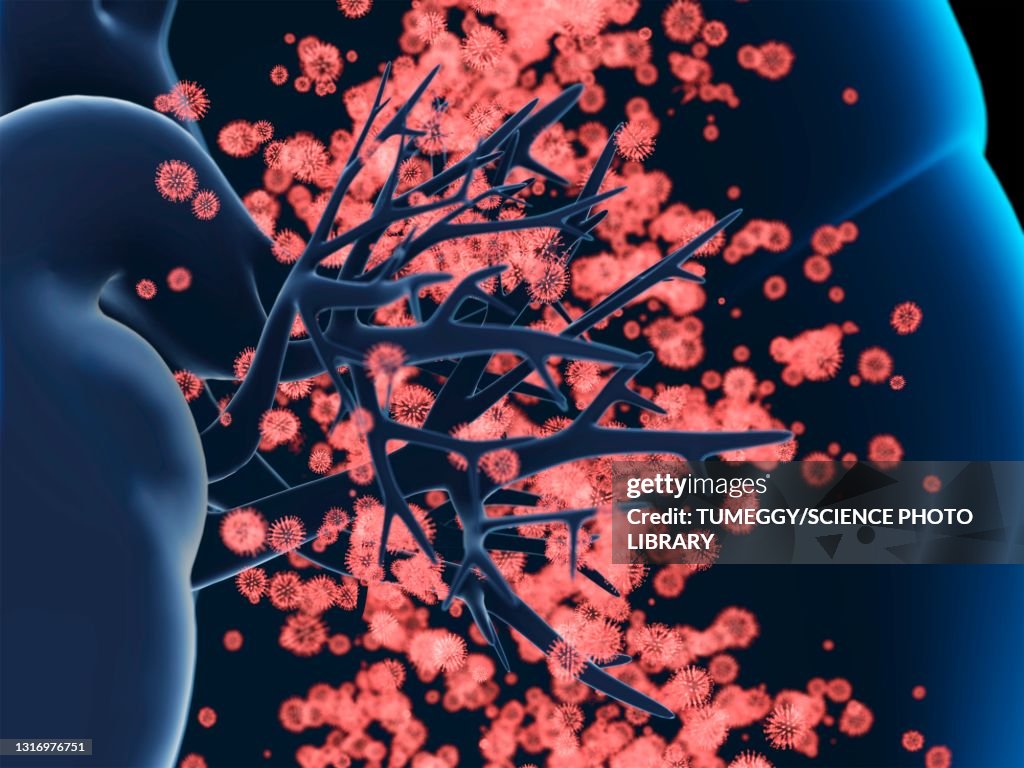 Viral lung infection, illustration