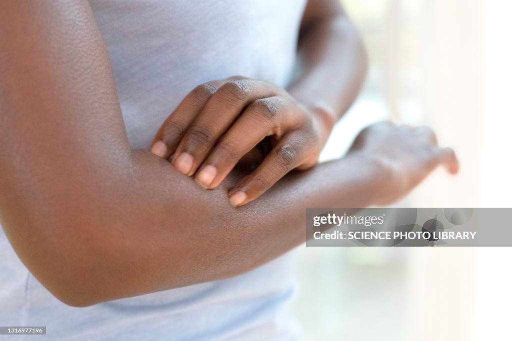 Woman scratching her arm