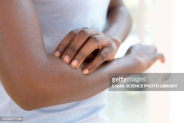 woman scratching her arm - human arm stock pictures, royalty-free photos & images