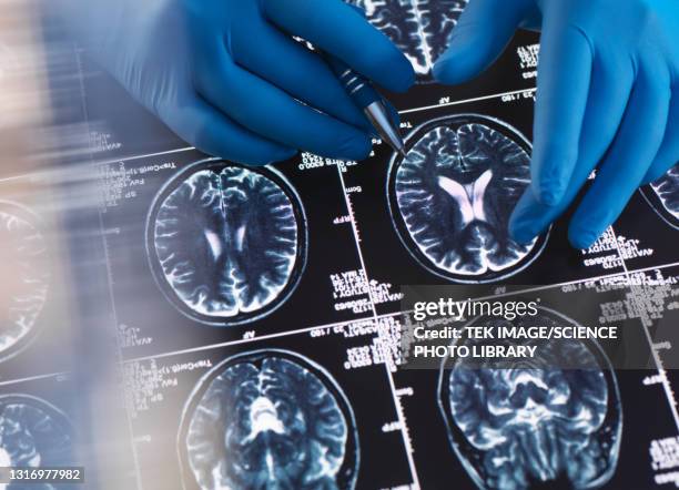 neurology diagnosis - condición fotografías e imágenes de stock