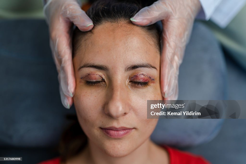 Portrait of Young woman who had Eye Lid Surgery