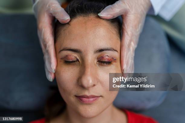 portrait of young woman who had eye lid surgery - surgery stitches stock pictures, royalty-free photos & images