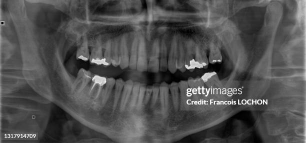 Radiographie d'une bouche réalisée avec une caméra à rayons X.