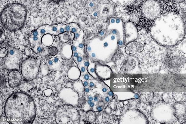 Image au microscope électronique du premier cas américain de COVID-19, les particules virales sphériques, colorisées en bleu, contiennent une coupe...