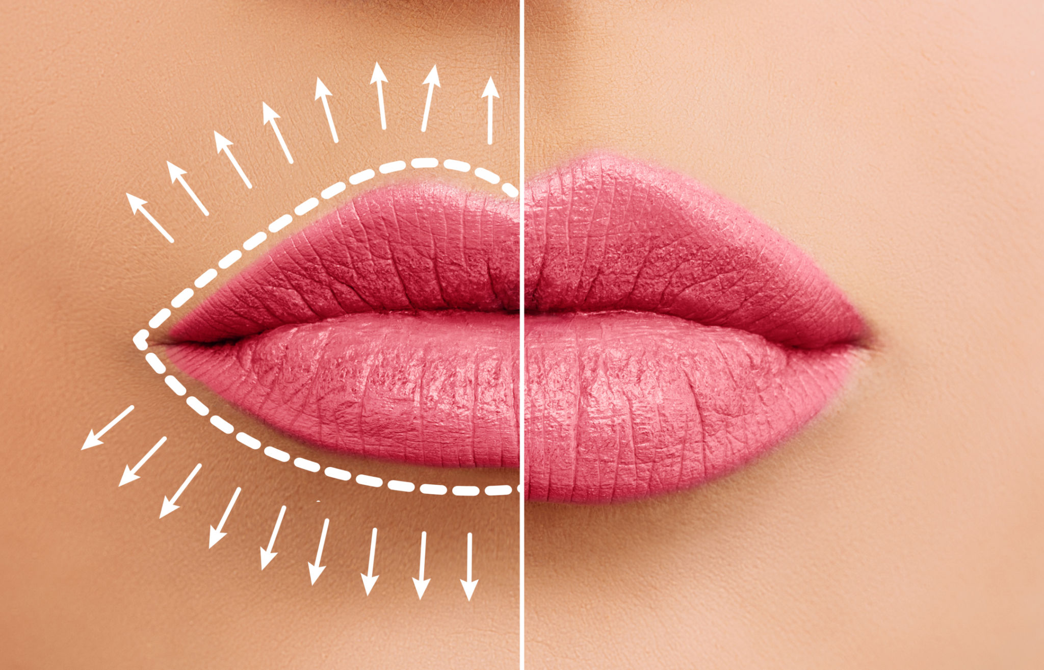 modern lip enhancement