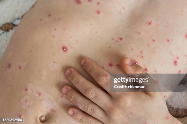 part of child's body with chickenpox bubbles - kid acne stock pictures, royalty-free photos & images