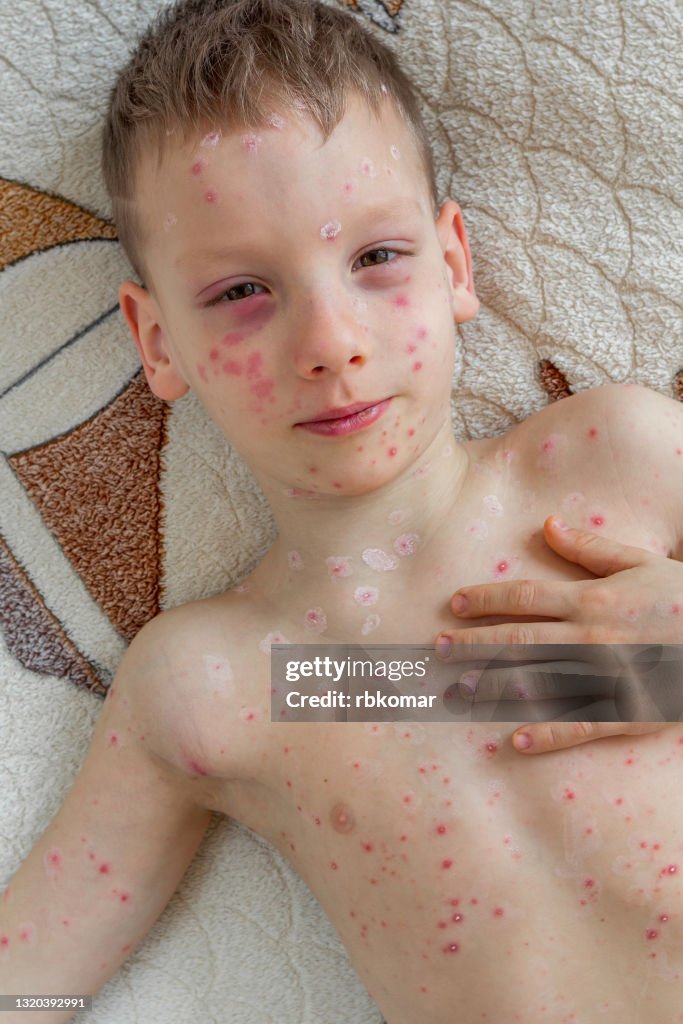 Checken Box Rash Toddler Scratching Chicken Pox Rash On On The Skin Of The Face And Body ...