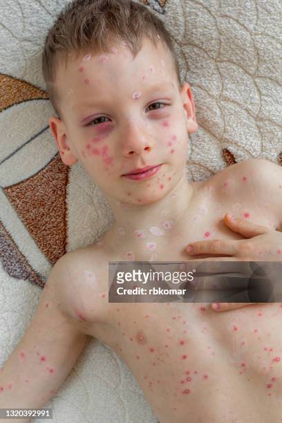 toddler scratching chicken pox rash on on the skin of the face and body - chickenpox stock pictures, royalty-free photos & images