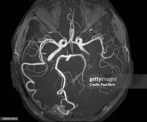 a brain arteriovenous malformation (avm) in the parietal lobe, seen on mra (magnetic resonance angiography) of the brain - human artery foto e immagini stock
