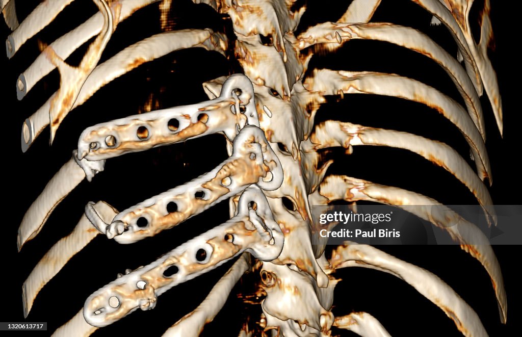 Titanium Ribs Implanted Into The Chest Wall 3d Ct Computer Tomography ...