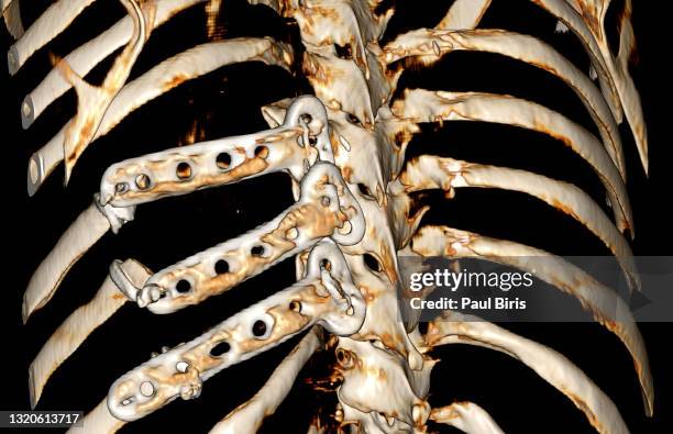 titanium ribs implanted into the chest wall , 3d ct computer tomography reconstruction - vertebral fracture stock pictures, royalty-free photos & images