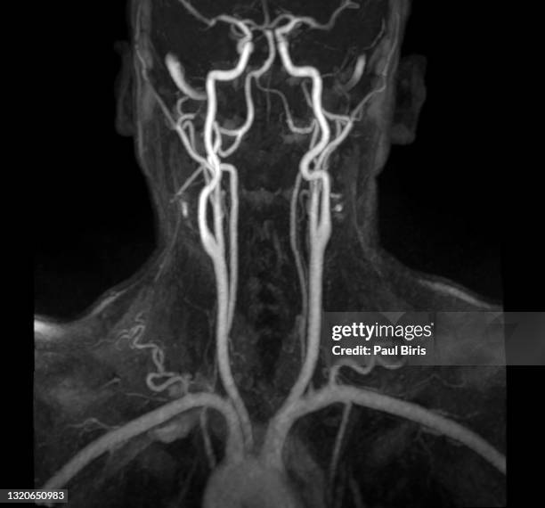 mri image (mra) show head and neck artery - artériosclérose photos et images de collection