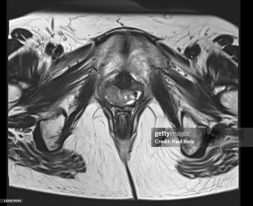 Magnetic Resonance Images of Woman Pelvis with Vaginal cancer, axial T2 view