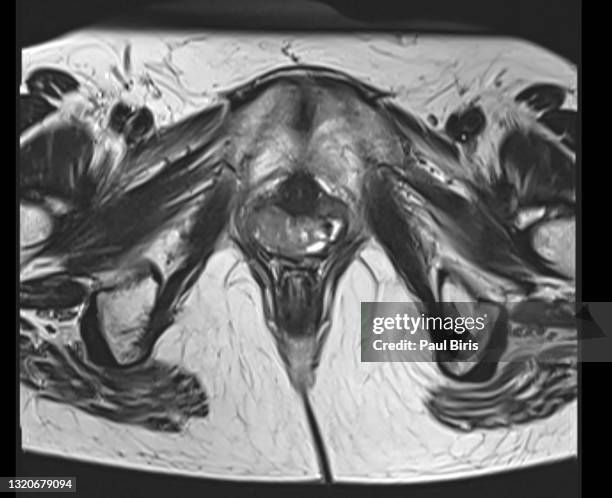 magnetic resonance images of woman pelvis with vaginal cancer, axial t2 view - cervical cancer stock pictures, royalty-free photos & images