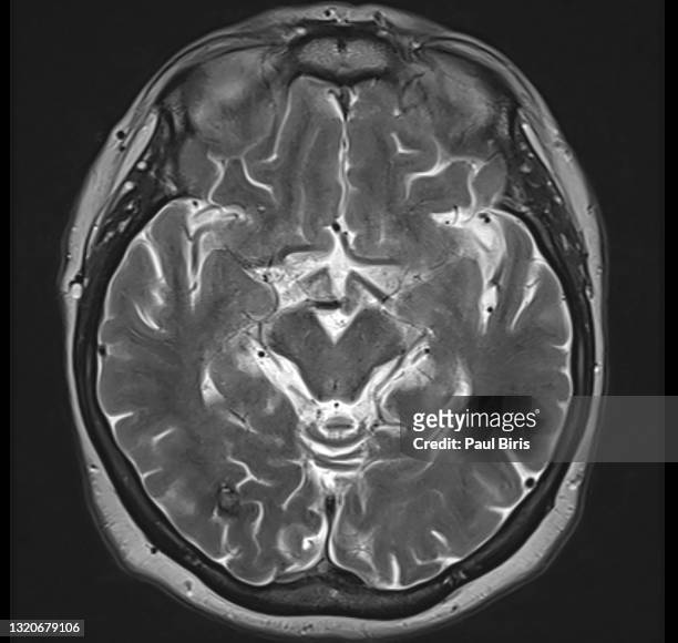 vascular malformation in the brain (cavernoma) seen on t2 mri image in the occipital right lobe - petechiae stockfoto's en -beelden