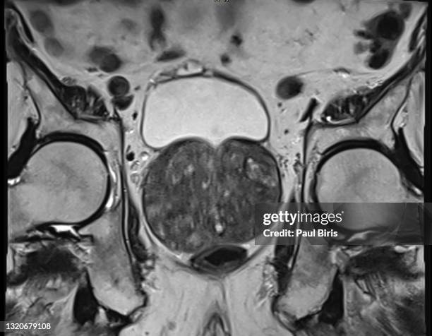 benign prostatic hyperplasia (bph) or prostate adenoma seen on mri examination , axial t2 image - bulk test stock pictures, royalty-free photos & images