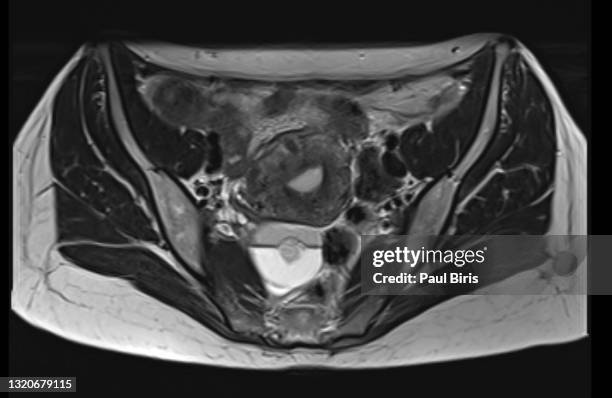 ovarian dermoid cyst and mature cystic ovarian teratom seen on mri examination of the female pelvis, axial view - 卵巣癌 ストックフォトと画像