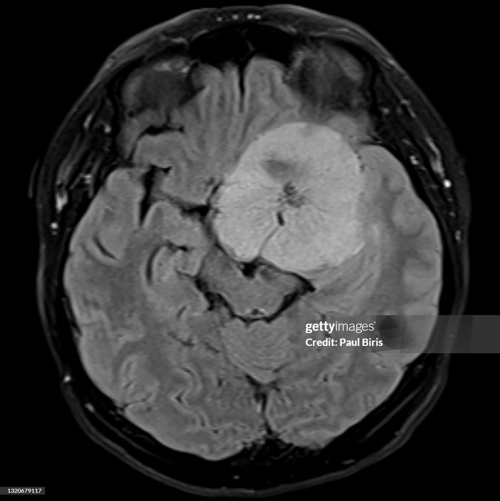 MRI of a benign brain tumor (Sphenoid meningioma) , axial Flair view