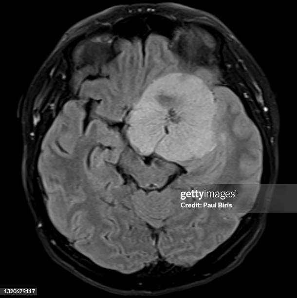 mri of a benign brain tumor (sphenoid meningioma) , axial flair view - brain tumour stock pictures, royalty-free photos & images