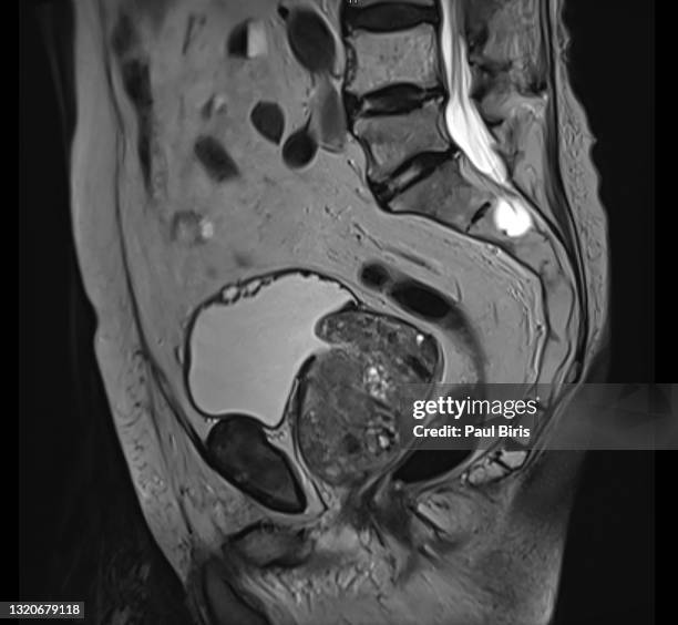 benign prostatic hyperplasia (bph) or prostate adenoma seen on mri examination, sagital t2 image - antígeno prostático específico fotografías e imágenes de stock