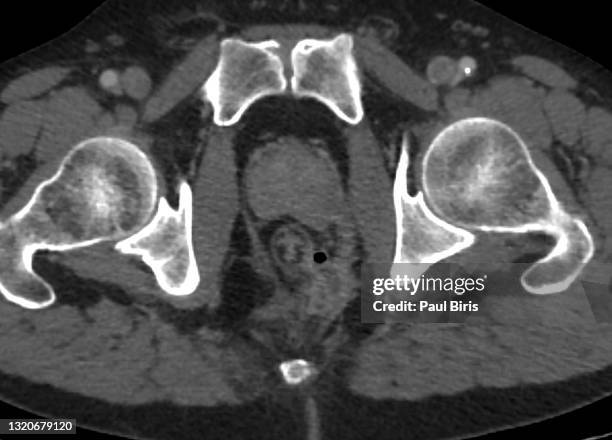 perianal abscess seen on axial ct computer tomography image - anus foto e immagini stock