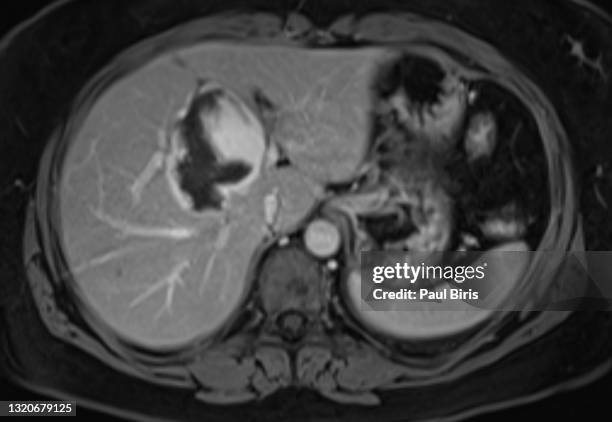 hepatic hemangiomas seen on axial images on mri examination after gadolinium contrast injected - dalende aorta stockfoto's en -beelden