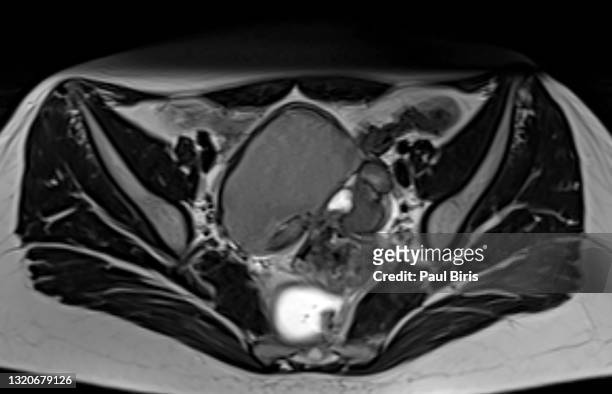 mri pelvis of a woman - benigne tumor bilateral ovarian endometriosis, t2 axial view - cyst fotografías e imágenes de stock