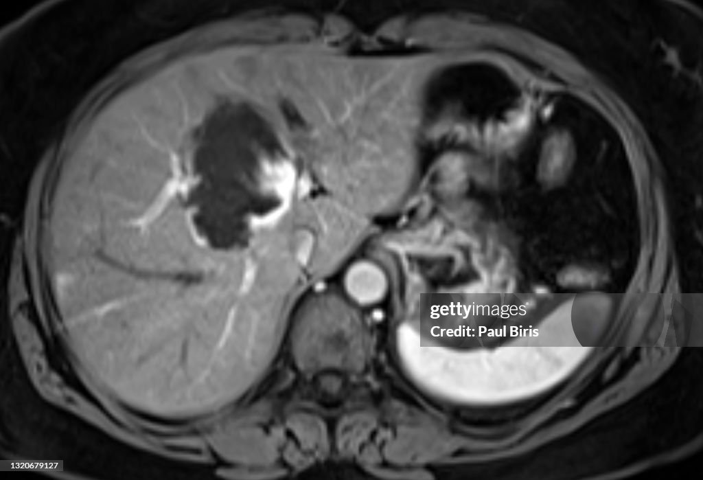 Hepatic hemangiomas seen on axial images on MRI examination after gadolinium contrast injected