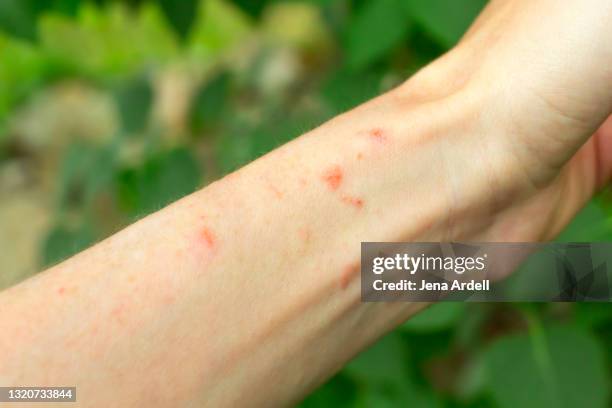 poison ivy rash on arm - blister stock pictures, royalty-free photos & images