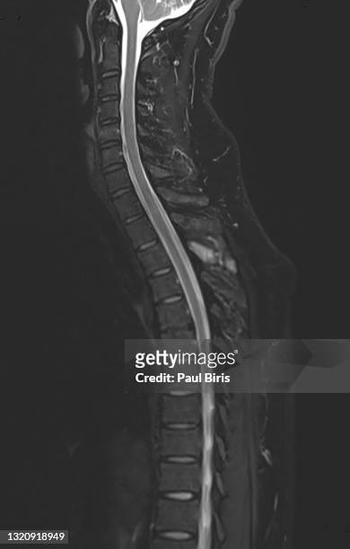 thoracic spine vertebral fracture  seen on mri sagittal image - hernia stockfoto's en -beelden