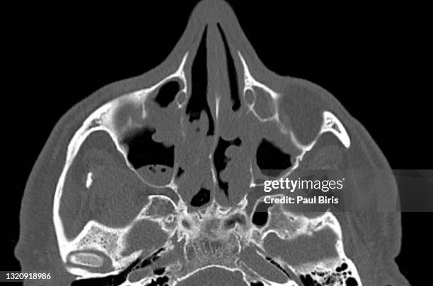 sinonasal polyposis , axial view , computer tomography ct - long nose stockfoto's en -beelden