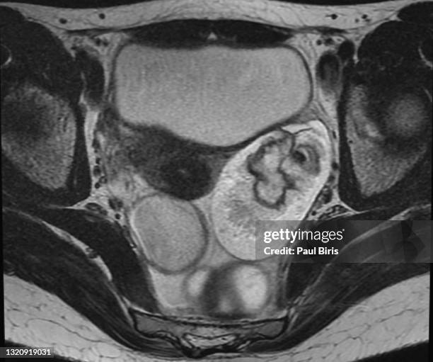 ovarian dermoid cyst or mature cystic ovarian teratoma seen on t2 mri image, axial view (magnetic resonance) - ovaries stock pictures, royalty-free photos & images