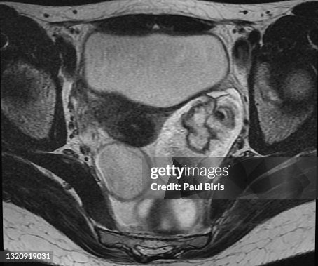 Ovarian dermoid cyst or mature cystic ovarian teratoma seen on T2 MRI image, axial view (magnetic resonance) Ovarian dermoid cyst or mature cystic ovarian teratoma seen on T2 MRI image, axial view (magnetic resonance)